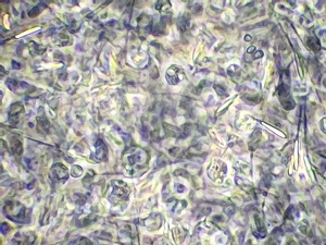 A semen sample containing an infection